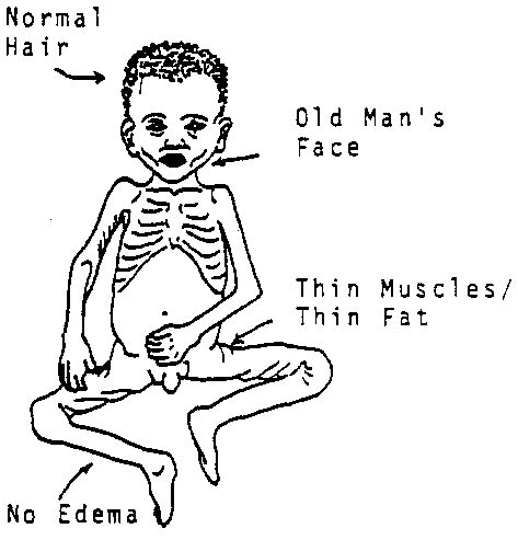 marasmus medical articles
