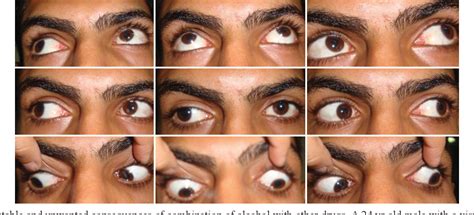 Illicit Drugs Effects On Eye Semantic Scholar