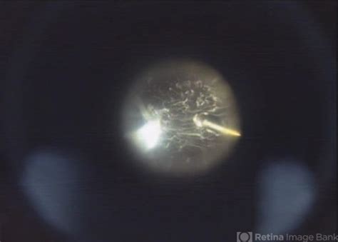 Vitrectomy for Asteroid Hyalosis - Retina Image Bank