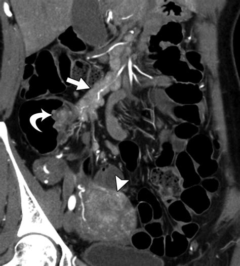 Imaging Features Of Carcinoid Tumors Of The Gastrointestinal Tract Ajr