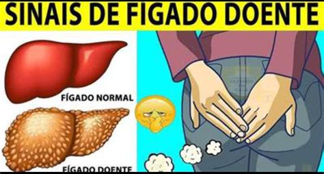 10 Sinais de FÍGADO doente Os sinais que seu FÍGADO está doente estão