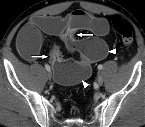 Ct Enterography Principles Trends And Interpretation Of Findings