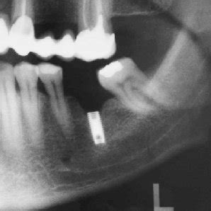 PDF Osseointegrated Implant Fracture Causes And Treatment