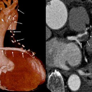 CT angiography showing (A) the patency of the great saphenous vein... | Download Scientific Diagram