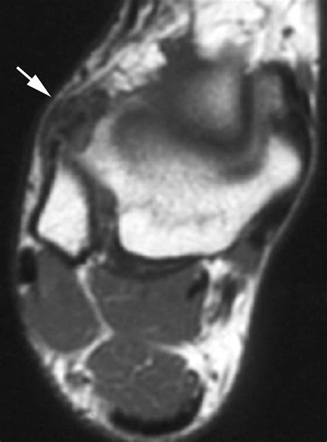 Mr Imaging Of Ankle Impingement Syndromes Ajr