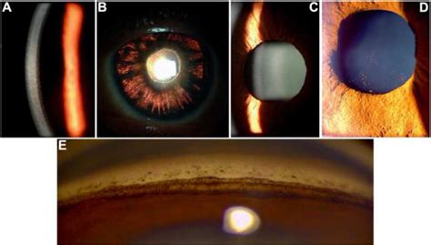 Pigment Dispersion Syndrome And Its Implications For Glaucoma Survey