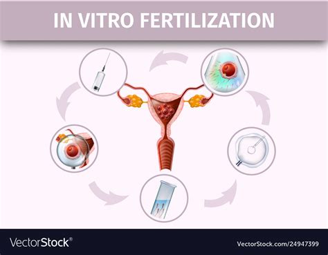 Human in vitro fertilization stages infographic Vector Image