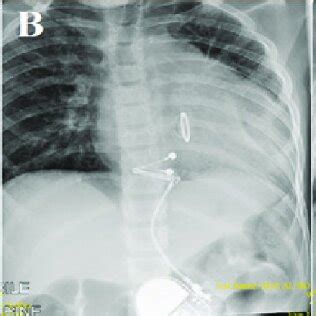 Chest radiograph showing (A) the permanent epicardial pacemaker system ...