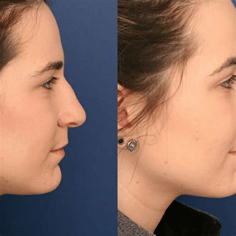 Before And After Plastic Surgery Results Top Surgeons Mexico