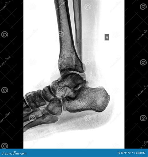 Ankle Joint X-ray Image Lateral View on Isolated White Background for ...