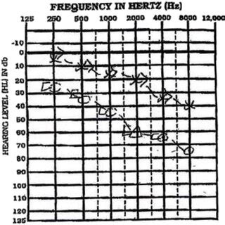 Audiogram shows moderate to severe sensorineural hearing loss on the ...