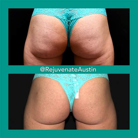 Specials Rejuvenate Austin Austins Premier Medspa