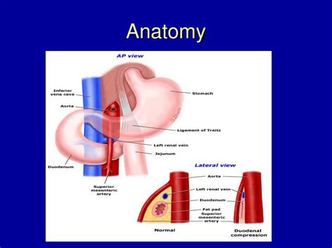 PPT - Superior Mesenteric Artery (SMA) Syndrome PowerPoint Presentation - ID:1571556