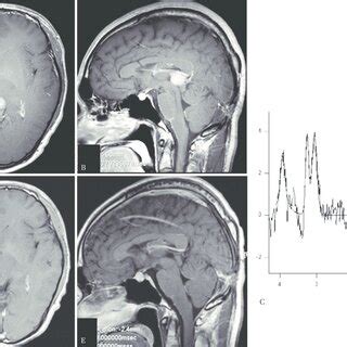 A And B Axial A And Sagittal B T 1 Weighted Magnetic Resonance