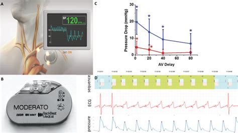 Cardiac neuromodulation therapy BackBeat. (A,B) Implantable pulse... | Download Scientific Diagram