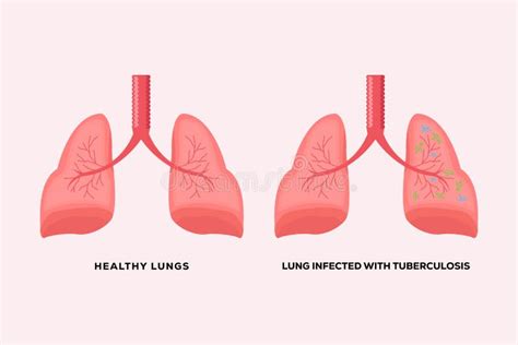 Healthy Lungs And Lungs Infected With Tuberculosis Stock Vector