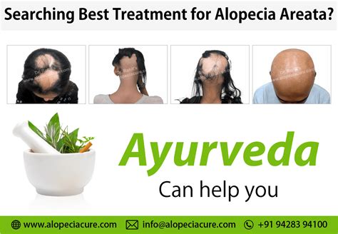 Alopecia Areata Treatment Types Causes