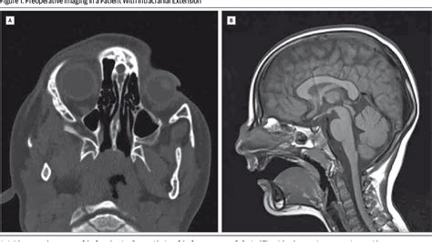 Figure 1 From Midline Approach To Pediatric Nasofrontal Dermoid Cysts