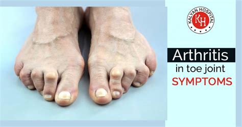 Symptoms of Arthritis in Toe Joint