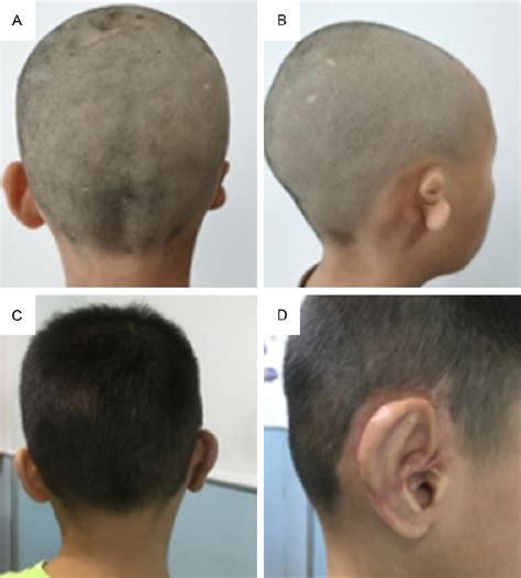 Figure 1 From Clinical Effect Evaluation And Complication Analysis Of