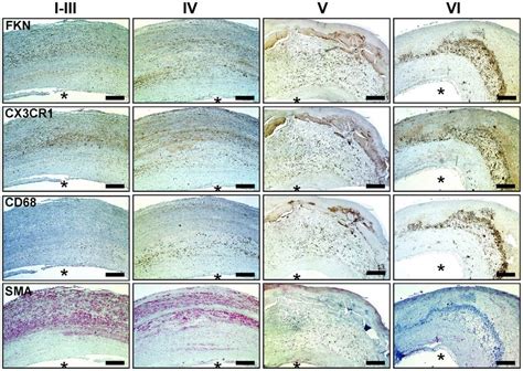 Immunohistochemistry Of FKN And CX3CR1 In Atherosclerotic Lesions Of