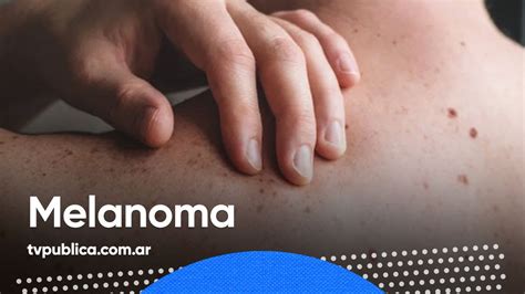 Cómo Identificar Y Prevenir Los Melanomas En Casa Salud Youtube