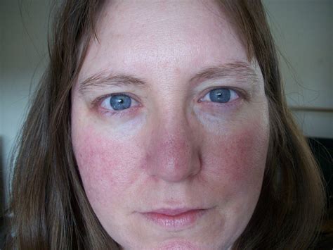 Understanding Rosacea Symptoms Universal Dermatology