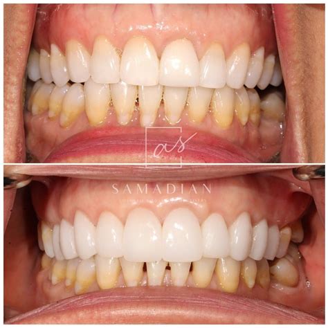 Smile Makeover Before And After