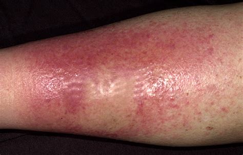 Cellulitis Leg 3 Infectionnet