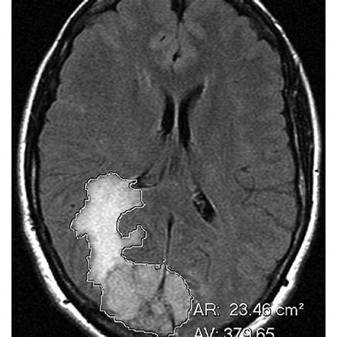 Pdf Differentiation Of Benign Angiomatous And Microcystic Meningiomas