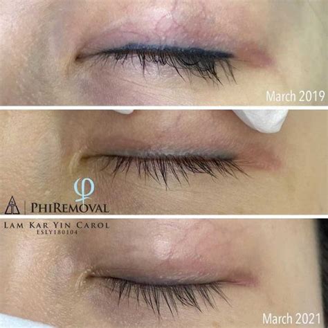 Eyeliner Tattoo Removal How To Remove Permanent Eyeliner