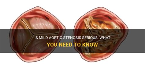 Is Mild Aortic Stenosis Serious: What You Need To Know | MedShun