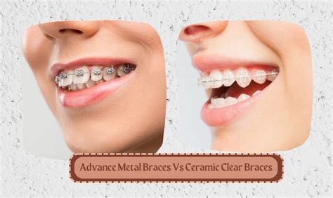 Advance Metal Braces Vs Ceramic Clear Braces