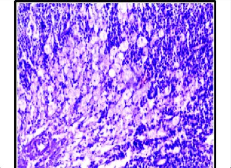 A Photograph Of H And E Stained Section Showing Mikulicz Cells Under