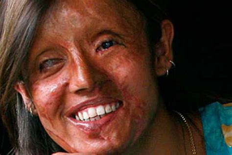 150 Acid Attacks On Women A Year One Man Is Saving Faces