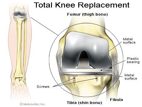 Hugh Blackley Total Knee Joint Replacement Knee Arthritis Surgery