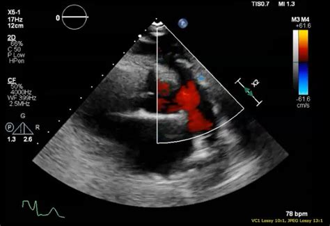 NEJM On Twitter A 21 Year Old Woman Gravida 1 Para 1 With Sickle