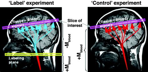 Comparative Overview Of Brain Perfusion Imaging Techniques Stroke