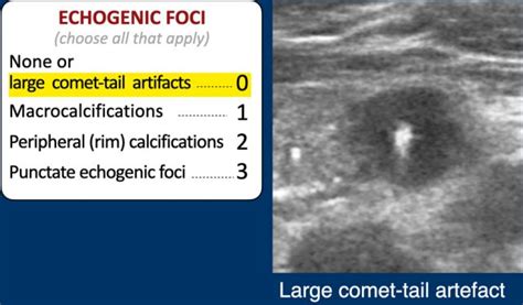 The Radiology Assistant Ti Rads Thyroid Imaging Reporting And Data