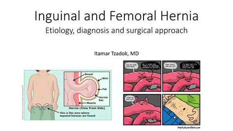 Inguinal And Femoral Hernia Ppt