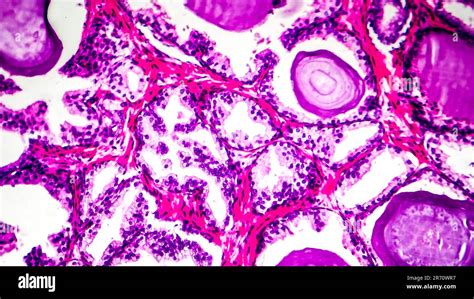 Histopathologie De L Hyperplasie De La Prostate Micrographe L Ger