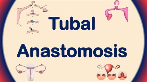 Tubal Anastomosis Tubal Ligation Reversal Tubal Reversal Procedure