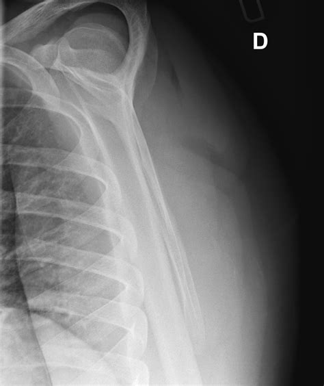 Hill Sachs Lesion Image Radiopaedia Org