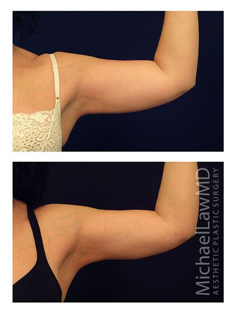 Arm Lift Patient 4 Raleigh Nc Plastic Surgeon Dr Michael Law