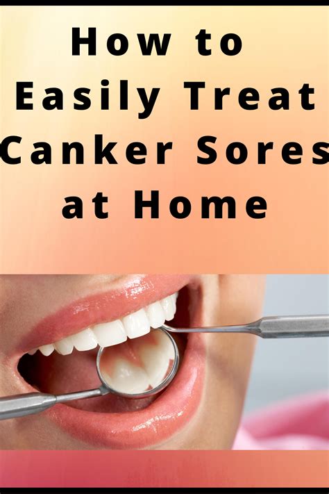 mouth ulcer home remedies 8