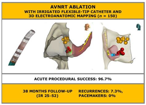 Jcdd Free Full Text Ablation Of Atrioventricular Nodal Re Entrant Tachycardia Combining