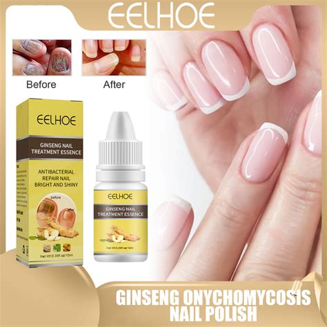 Eelhoe Ginseng Nail Treatment Essence Antifungal Cream Repair With