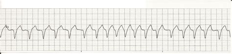 Float Nurse ACLS Review Wide Complex Tachycardia WCT Part 1