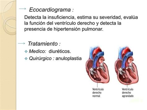 Valvulopatia Mitral Y Tric Spide Ppt