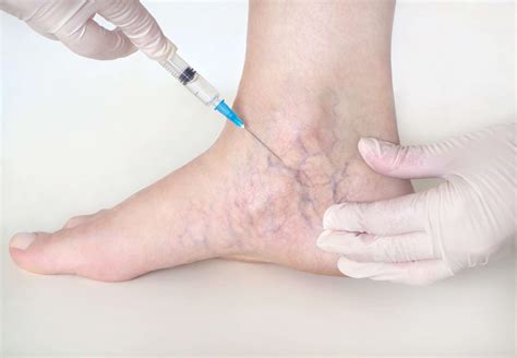 Laser Therapy for Varicose Veins Advanced Treatment Options